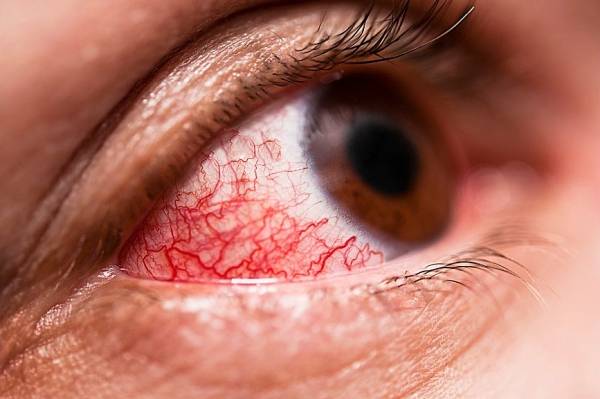 Conjunctivitis, eye virus